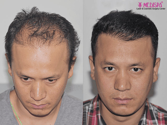 hair transplant jaipur